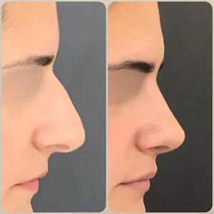 Esse é o resultado antes e depois de rinoplastia realizada pelo Dr. Luis Felipe Athayde pela técnica de Rinoplastia Preservadora com acesso fechado