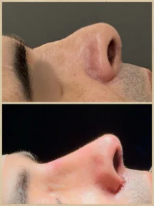 Antes e depois rinoplastia preservadora secundária e pós-trauma nasal – Dr. Luis Felipe Athayde