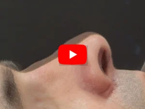 Rinoplastia antes e depois preservadora secundária e pós-trauma nasal – Vídeo YouTube – Dr. Luis Felipe Athayde