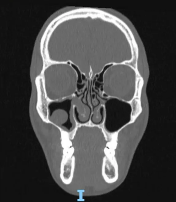 Tomografia dos Seios da Face com sinusopatia crônica, desvio de septo e hipertrofia de cornetos inferiores
