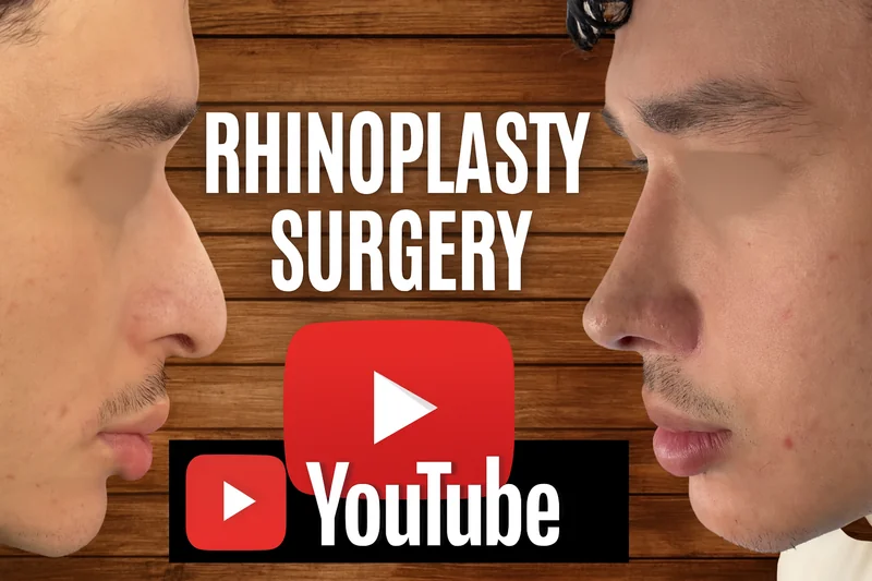 Assista ao vídeo completo do antes e depois da rinoplastia em ponta de nariz caída - Resultados impressionantes no YouTube Shorts