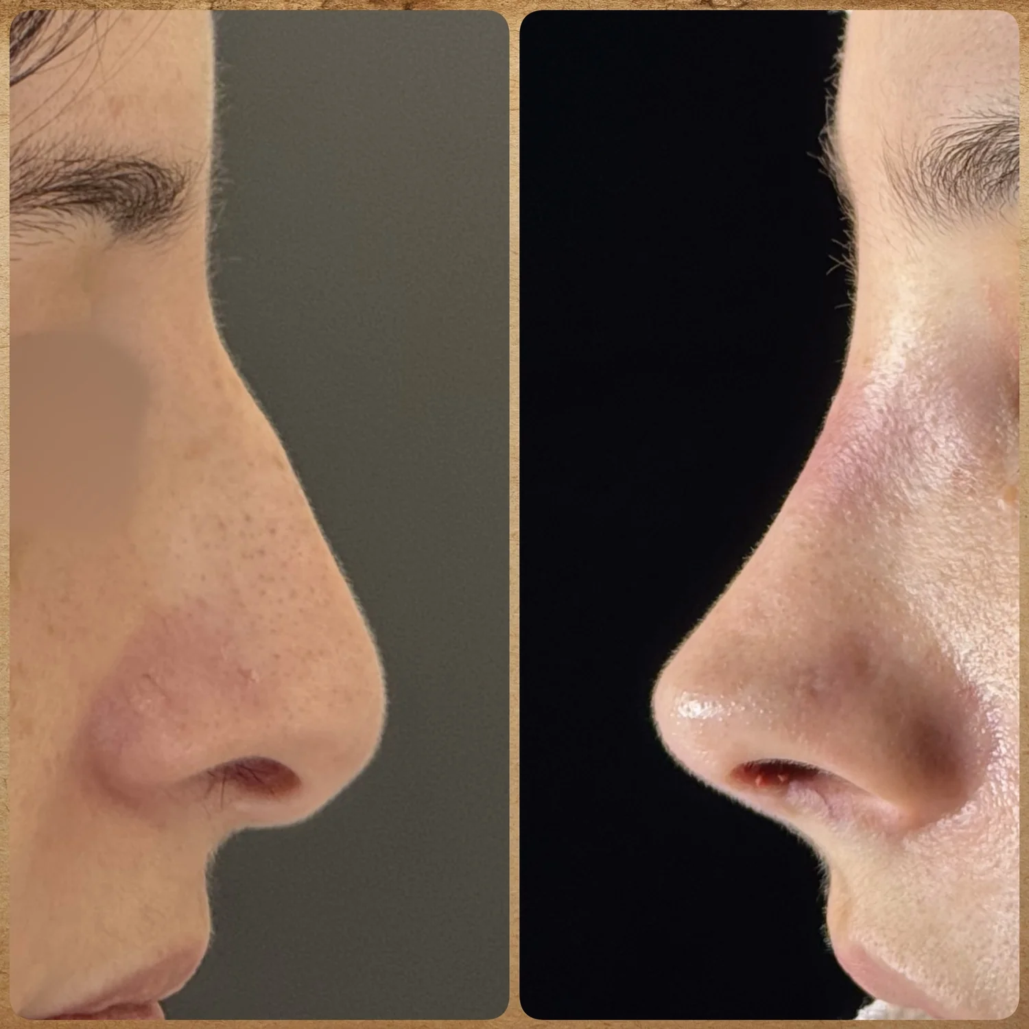 Imagem de um pós-operatório imediato, antes e depois de uma rinoplastia preservadora realizada pelo Dr. Luis Felipe Athayde, mostrando a correção da giba nasal, columela e o refinamento da ponta.