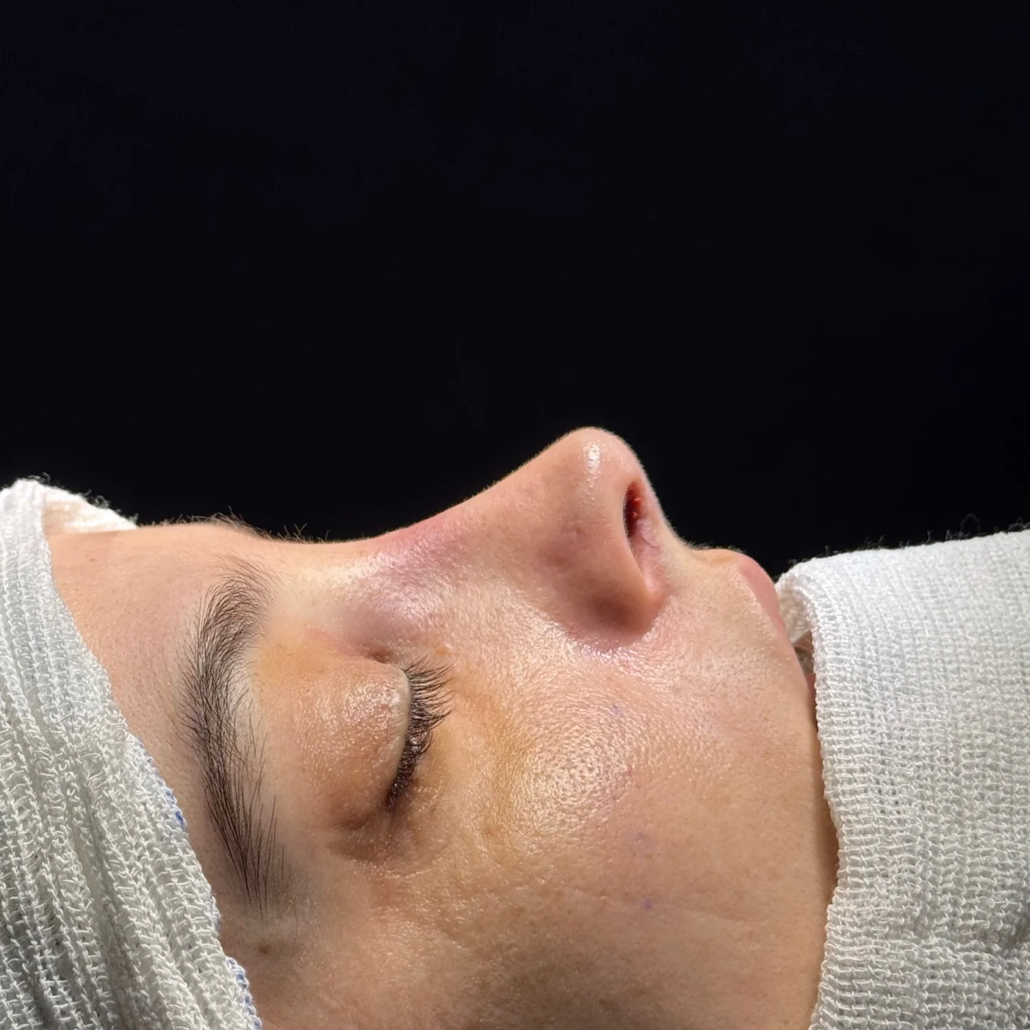 Imagem de pós-operatório imediato uma rinoplastia preservadora realizada pelo Dr. Luis Felipe Athayde, mostrando a correção da giba nasal, columela e o refinamento da ponta.