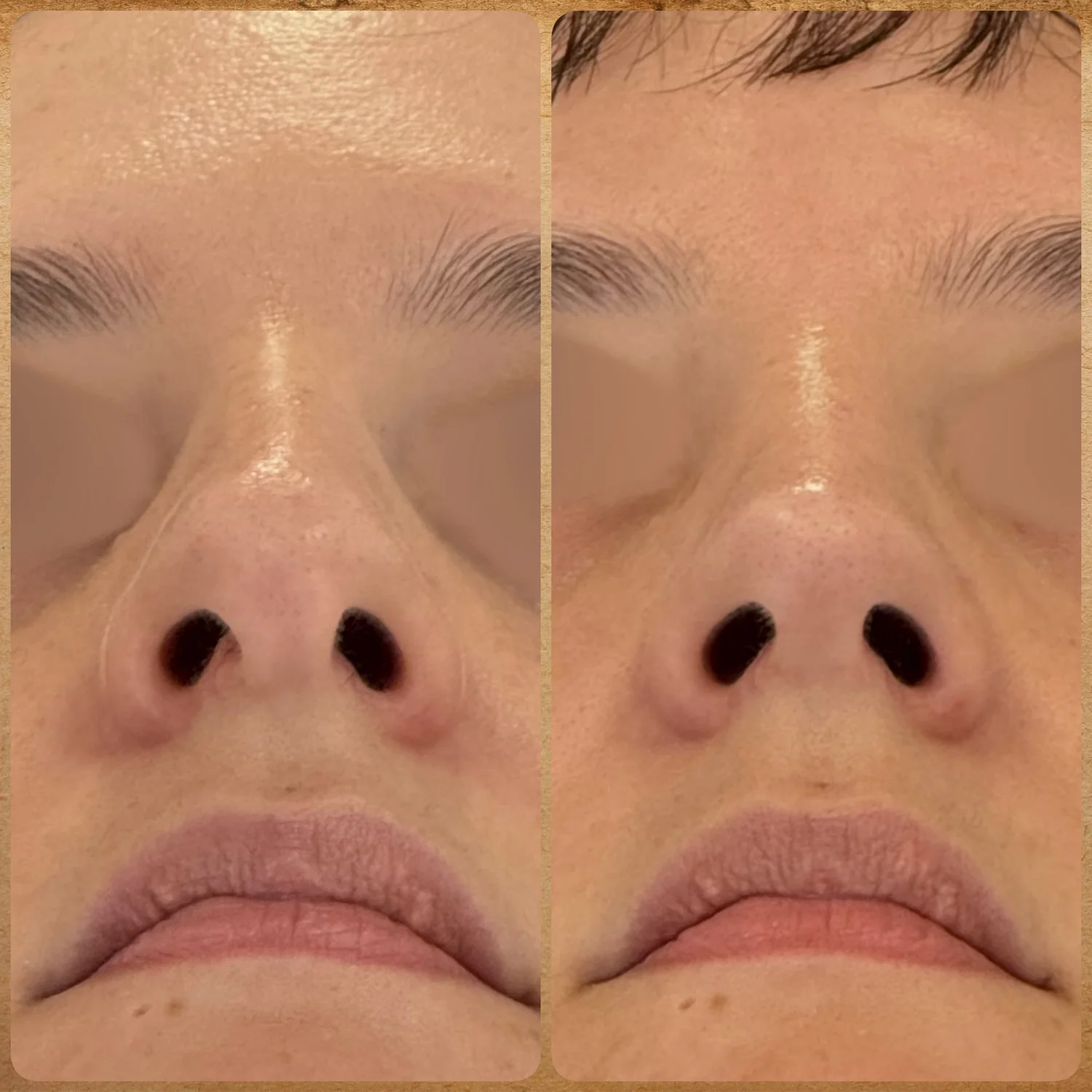 Imagem da vista base antes e depois de uma rinoplastia preservadora realizada pelo Dr. Luis Felipe Athayde, mostrando a correção da giba nasal, columela e o refinamento da ponta. Resultado de uma rinoplastia preservadora que realizei. Observe como a técnica permite um dorso nasal reto e natural, sem o aspecto de "nariz operado".