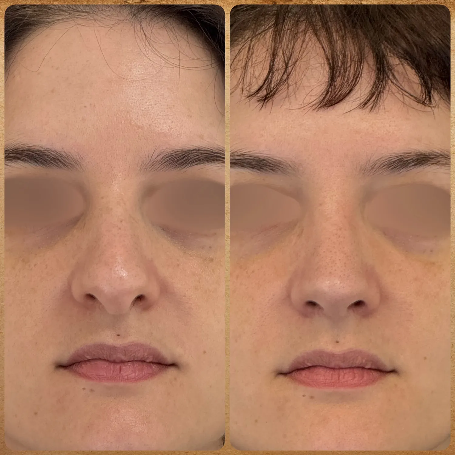 Imagem frontal de antes e depois de uma rinoplastia preservadora realizada pelo Dr. Luis Felipe Athayde, mostrando a correção da giba nasal, columela e o refinamento da ponta.