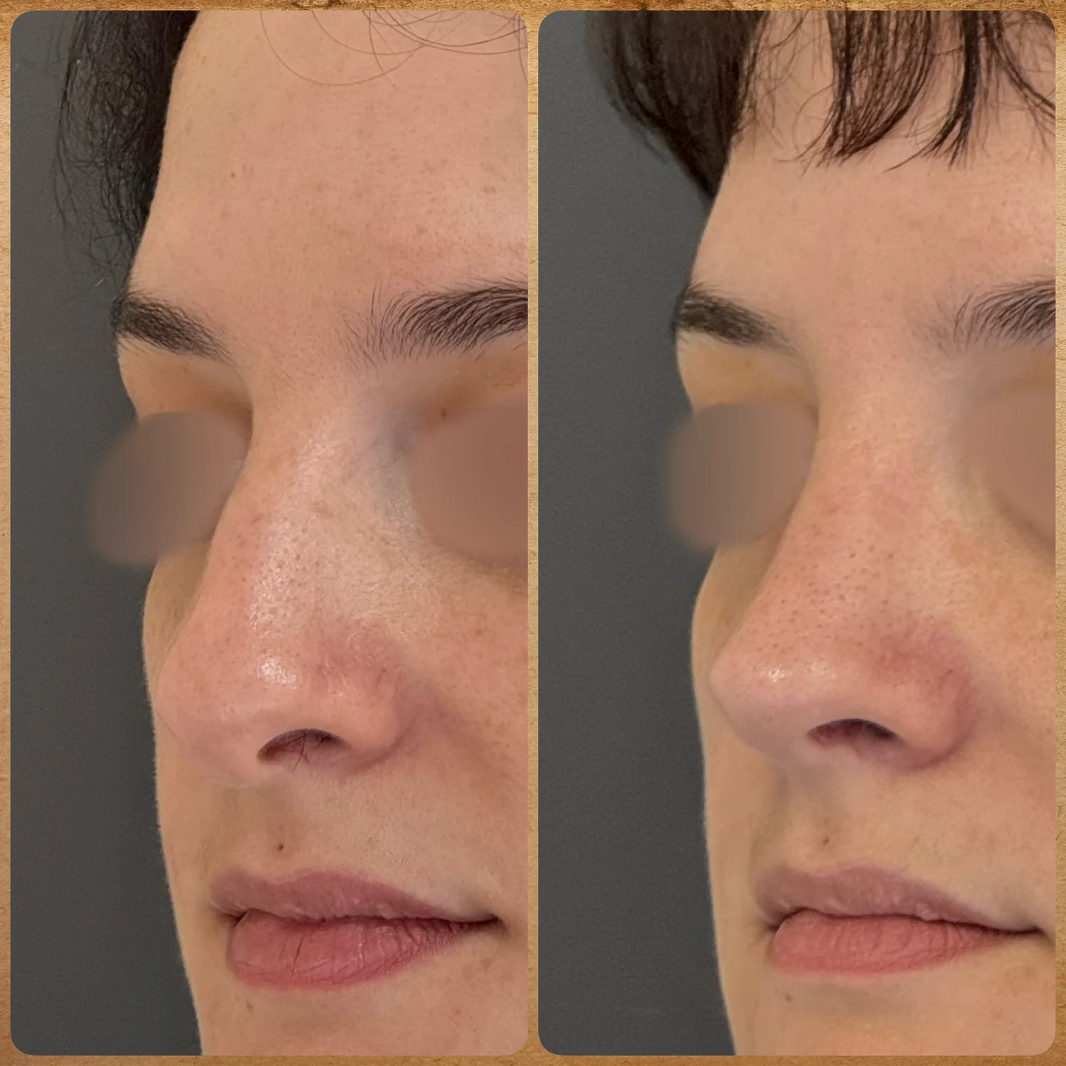 Imagem de meio perfil antes e depois de uma rinoplastia preservadora realizada pelo Dr. Luis Felipe Athayde, mostrando a correção da giba nasal, columela e o refinamento da ponta.