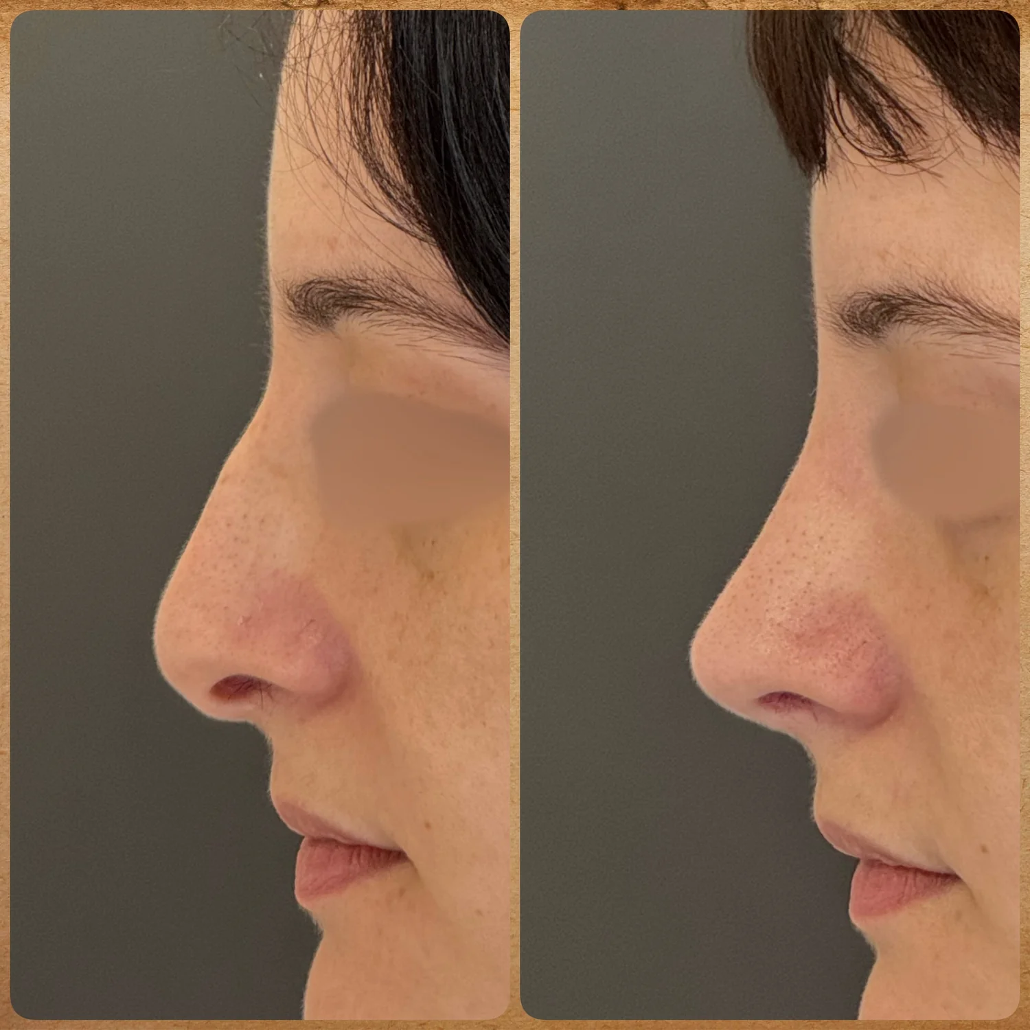 Imagem de antes e depois de uma rinoplastia preservadora realizada pelo Dr. Luis Felipe Athayde, mostrando a correção da giba nasal, columela e o refinamento da ponta.