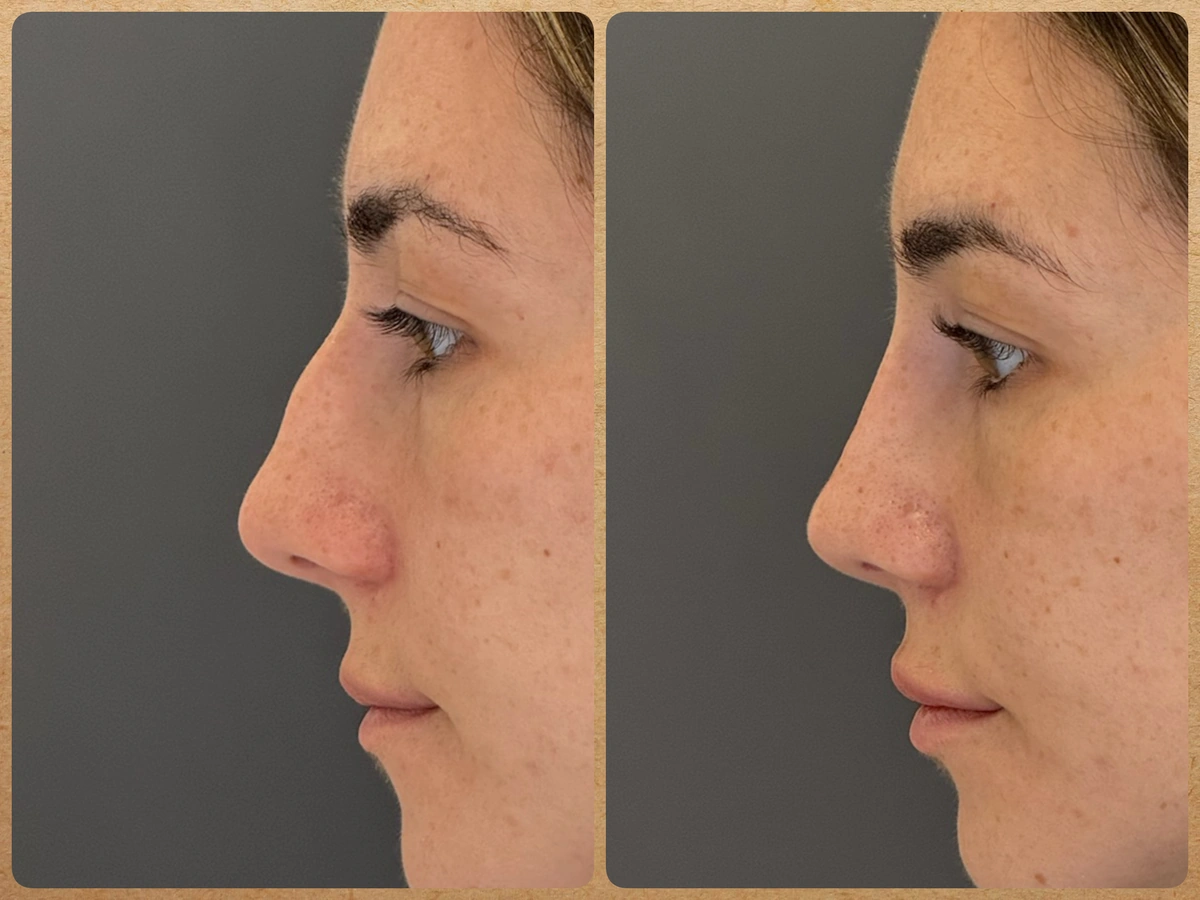 Antes e depois em perfil de rinoplastia preservadora para retirada da giba nasal preservando a ponta
