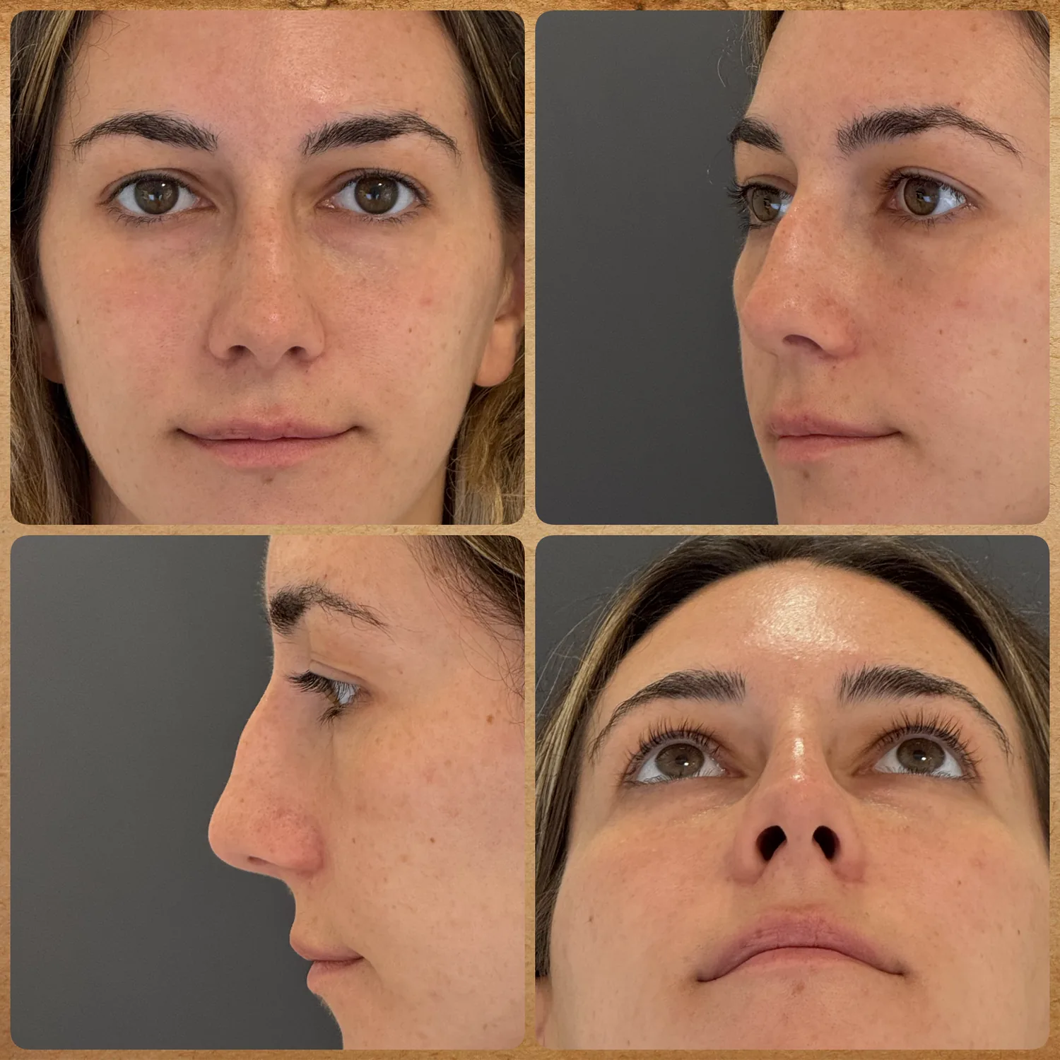 Antes da rinoplastia preservadora para retirada da giba nasal sem alterar a ponta do nariz