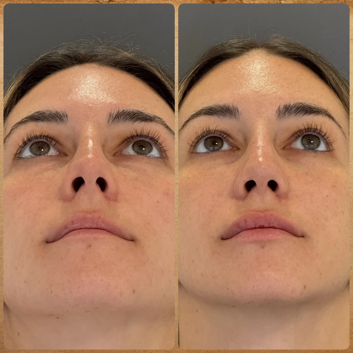 Visão da base antes e depois de rinoplastia preservadora sem alterar a ponta nasal