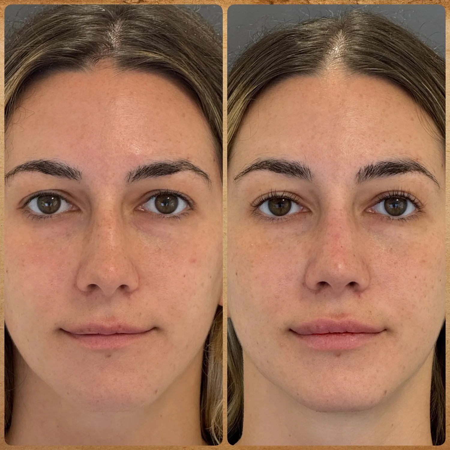 Antes e depois frontal de rinoplastia preservadora para retirada da giba nasal sem mexer na ponta