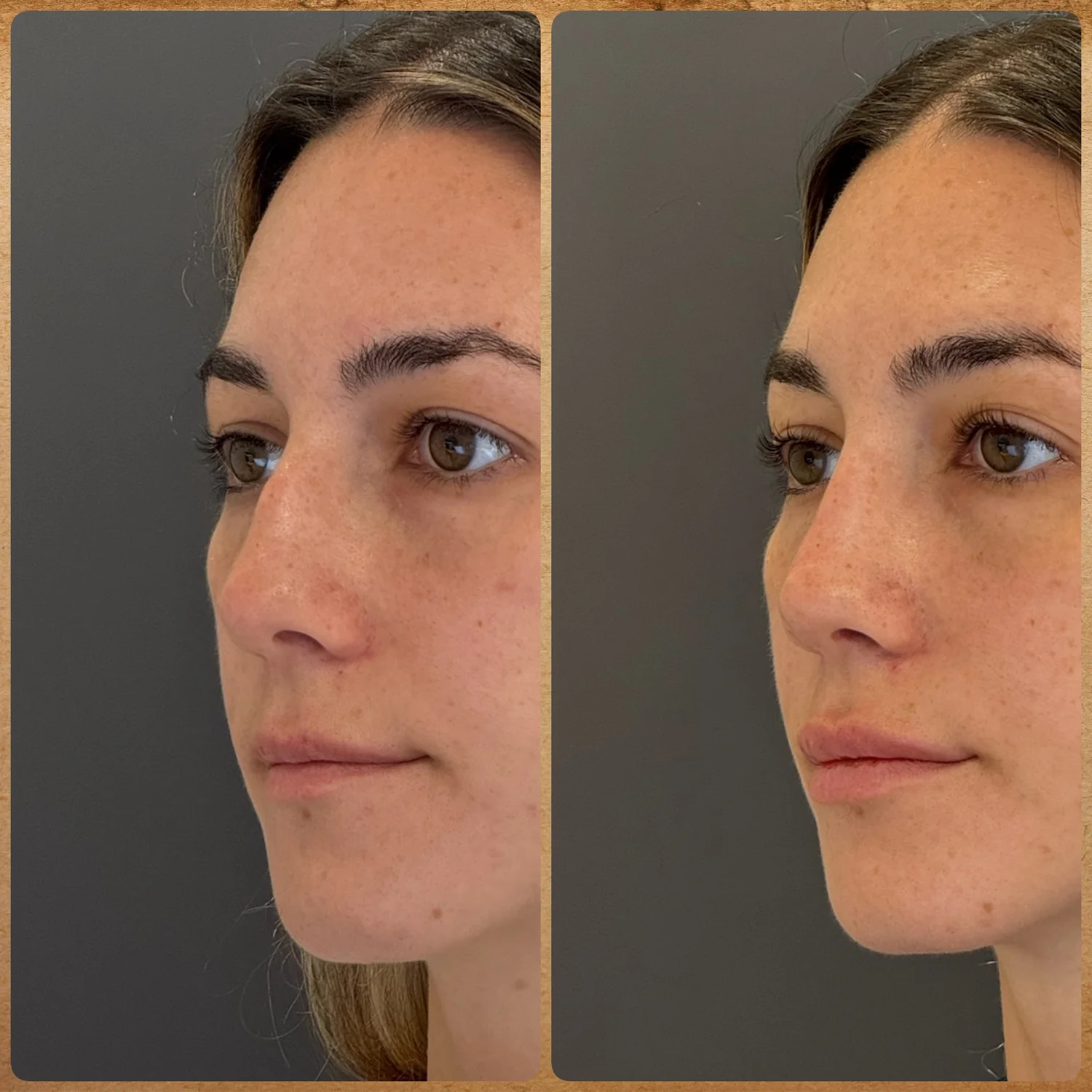 Antes e depois em meio perfil de rinoplastia preservadora para giba nasal sem alterar a ponta