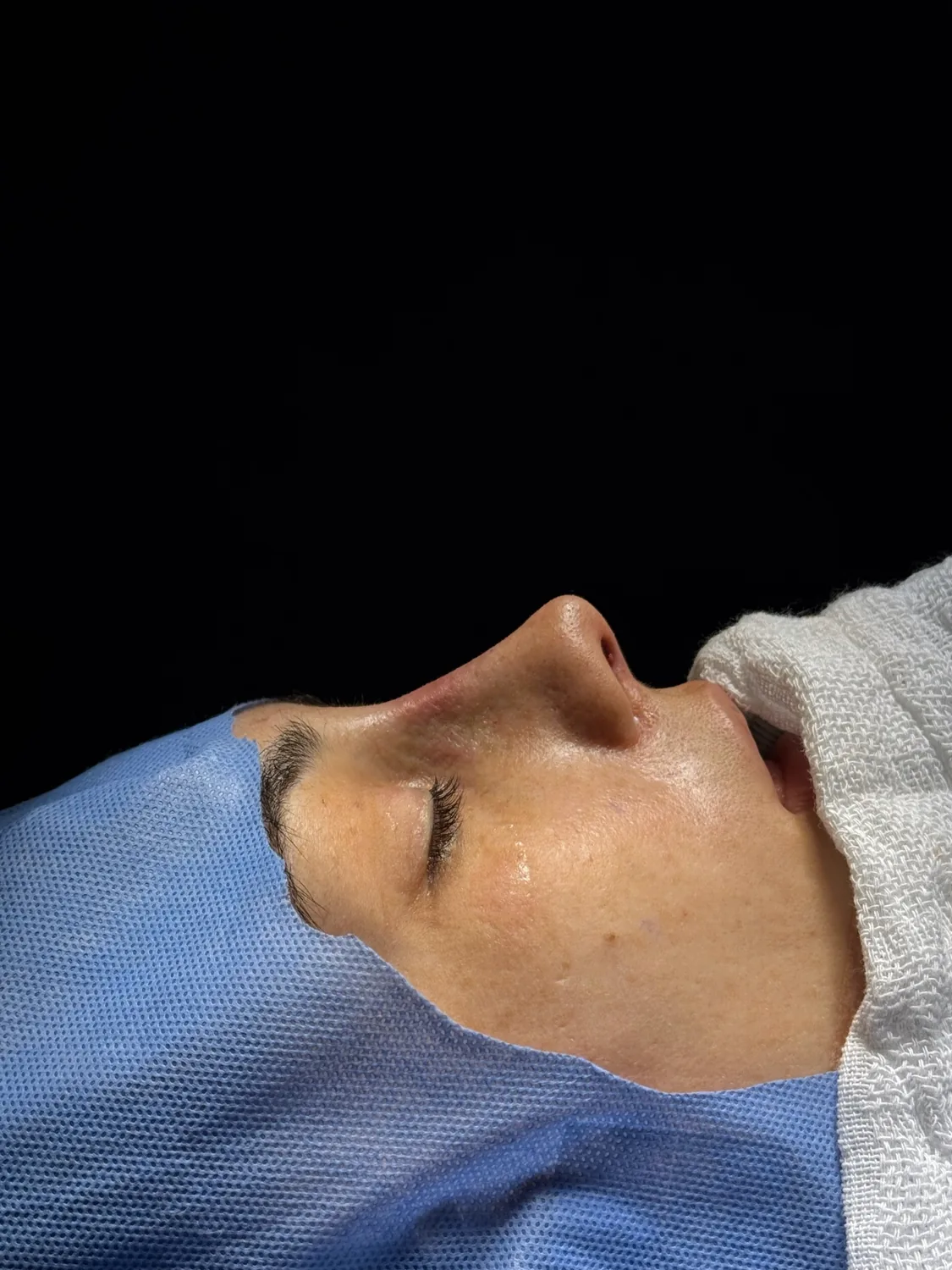 Pós-operatório imediato de rinoplastia preservadora para retirada da giba nasal