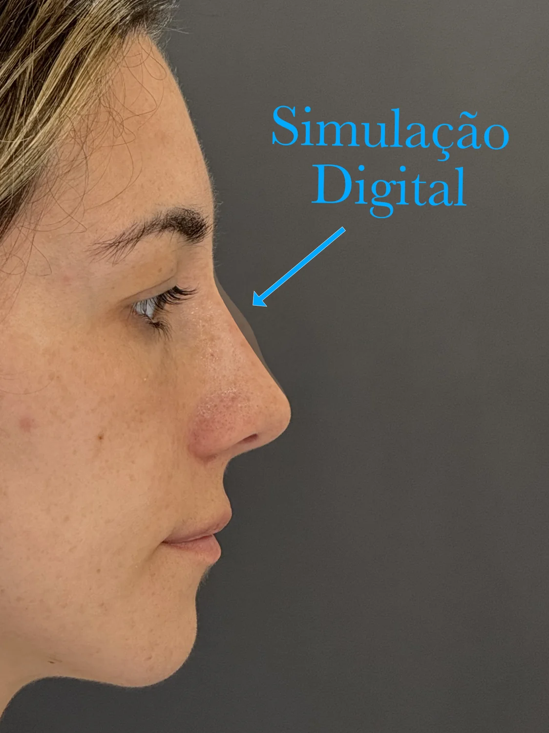 Simulação digital de rinoplastia preservadora para correção da giba nasal sem mexer na ponta