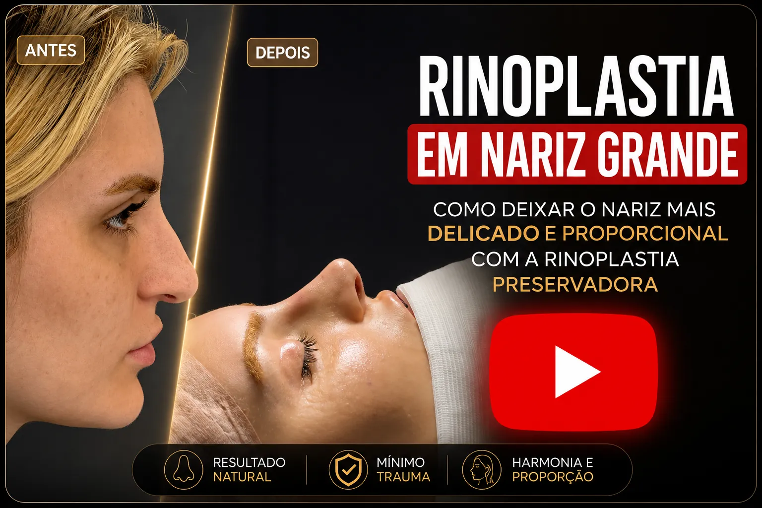 Antes e depois da Rinoplastia Preservadora em nariz grande Antes e depois de rinoplastia em nariz grande com redução da giba nasal, deprojeção da ponta e harmonização do perfil facial.
