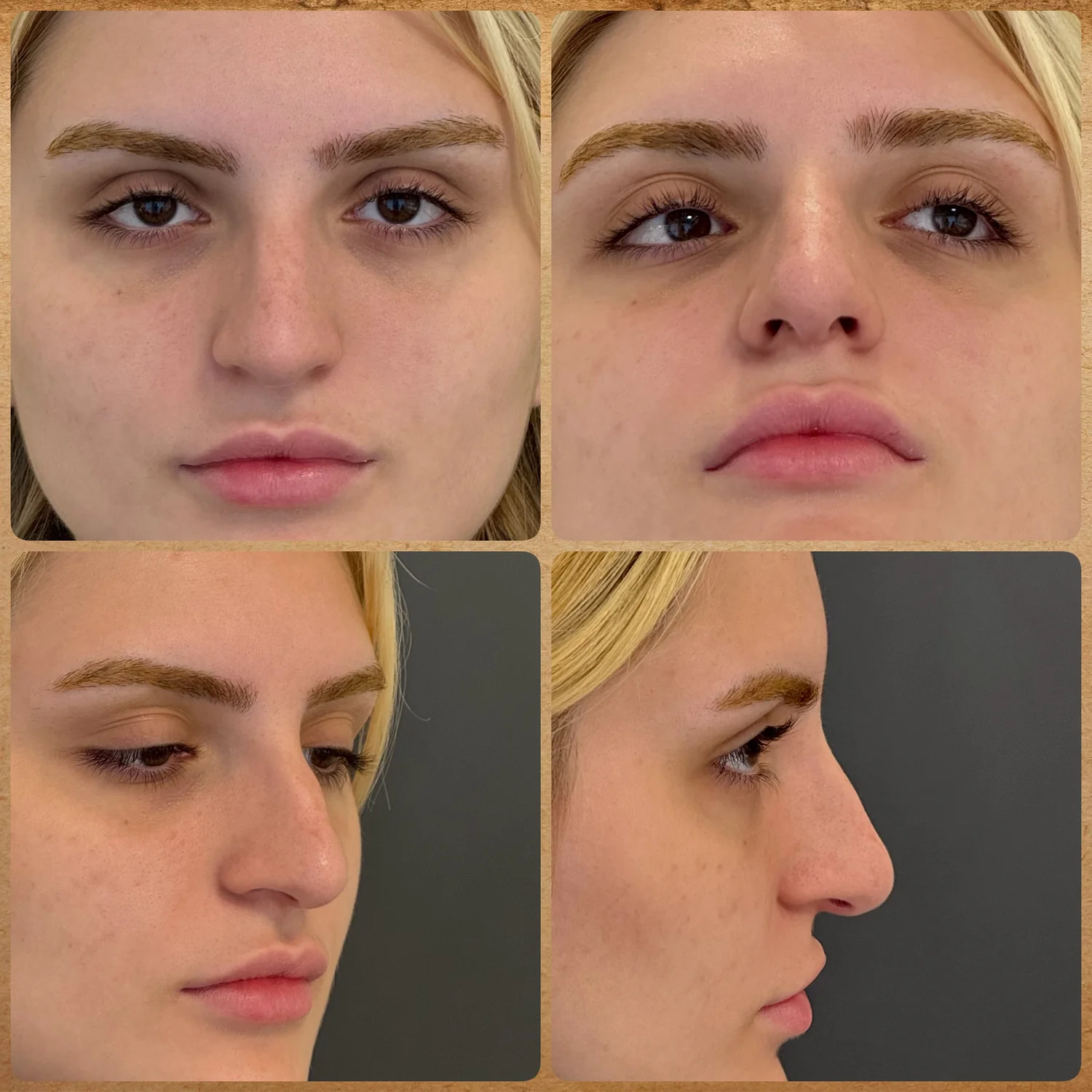 Antes da Rinoplastia Preservadora em nariz grande Antes da rinoplastia em nariz grande mostrando vista frontal, base nasal, perfil e meio perfil com giba nasal, ponta globosa, nariz longo e ponta hiperprojetada.