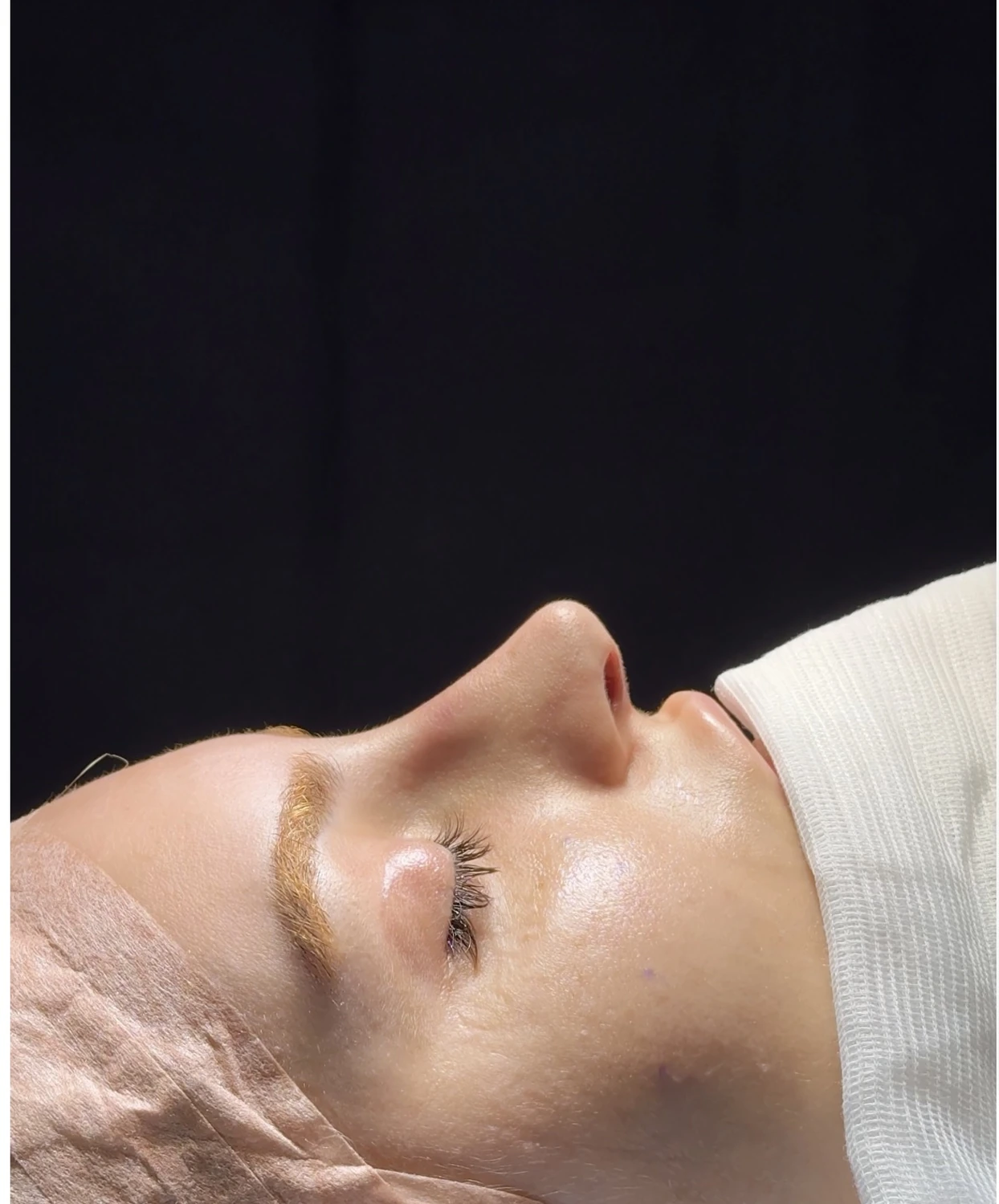 Resultado imediato da Rinoplastia Preservadora em nariz grande Resultado imediato da rinoplastia preservadora em nariz grande mostrando redução da giba nasal, deprojeção da ponta e refinamento do perfil nasal.