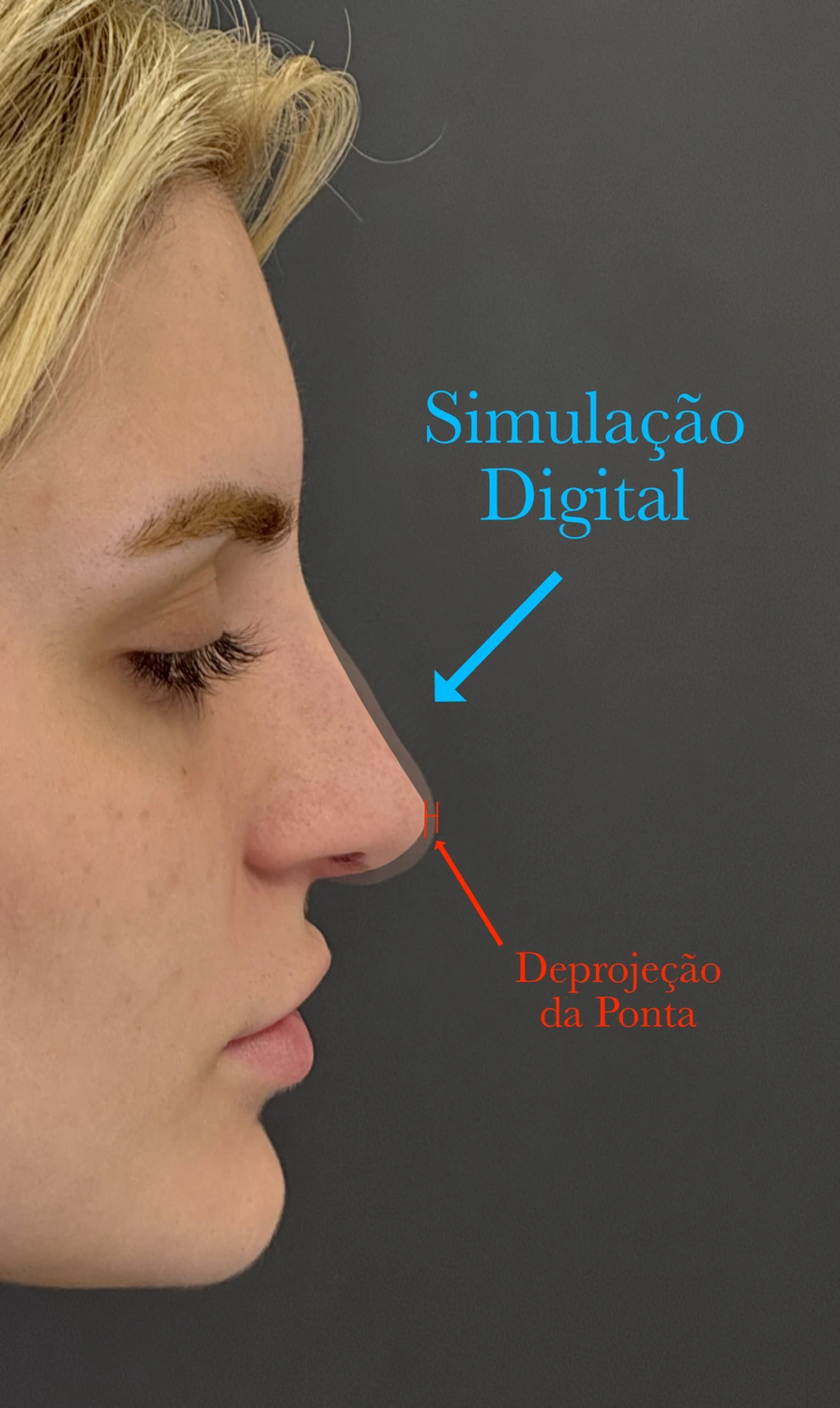 Simulação digital para rinoplastia em nariz grande Simulação digital de rinoplastia em nariz grande demonstrando redução da giba nasal, refinamento da ponta e harmonização do perfil facial.