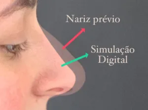 Rinoplastia - Simulação Digital