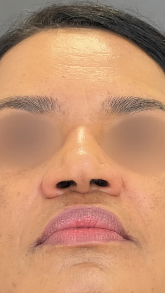 Imagem Rinoplastia nariz negroide antes