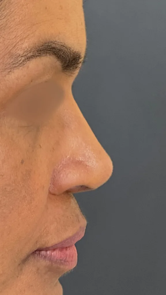 5 mês pós-operatório rinoplastia preservadora em nariz negroide