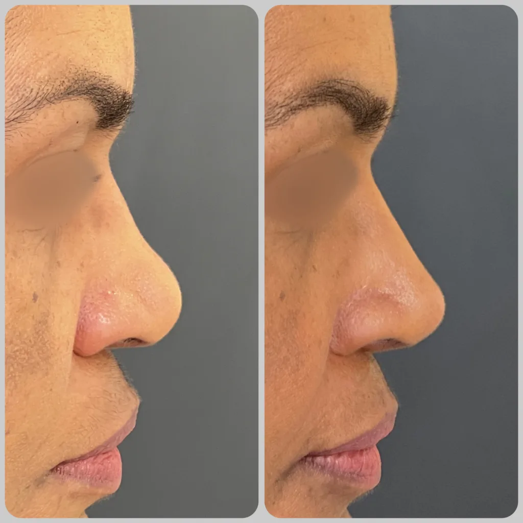 antes e depois de rinoplastia preservadora em nariz negroide