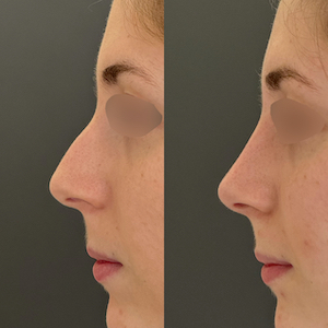 Alguns resultados de rinoplastia com imagens de perfil antes e depois