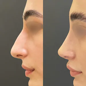 Esse é o resultado após 1 ano, de rinoplastia preservadora, cirurgia plástica de nariz, realizada pelo Dr. Luis Felipe Athayde sem cortes externos