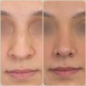 Esse é o resultado de frente de rinoplastia antes e depois realizada pelo Dr. Luis Felipe Athayde pela técnica de Rinoplastia Preservadora com acesso fechado