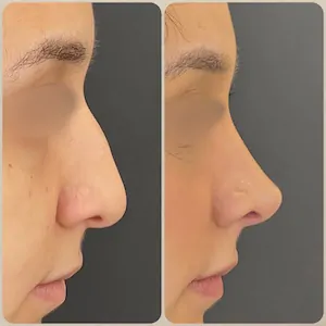 Esse é o resultado de perfil de rinoplastia antes e depois realizada pelo Dr. Luis Felipe Athayde pela técnica de Rinoplastia Preservadora com acesso fechado