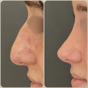 Esse é o resultado de rinoplastia antes e depois realizada pelo Dr. Luis Felipe Athayde pela técnica de Rinoplastia Preservadora com acesso fechado