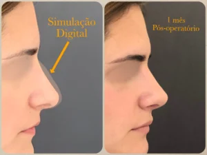 Esse é o resultado da simulação digital em rinoplastia antes e depois realizada pelo Dr. Luis Felipe Athayde pela técnica de Rinoplastia Preservadora com acesso fechado