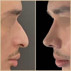 Rinoplastia em ponta de nariz caída - transformação completa antes e depois em perfil lateral