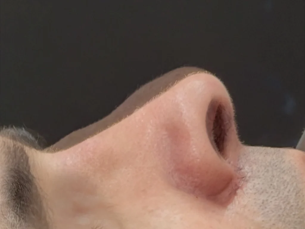 Rinoplastia antes e depois preservadora secundária e pós-trauma nasal – Dr. Luis Felipe Athayde