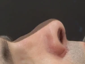 Rinoplastia antes e depois preservadora secundária e pós-trauma nasal – Dr. Luis Felipe Athayde