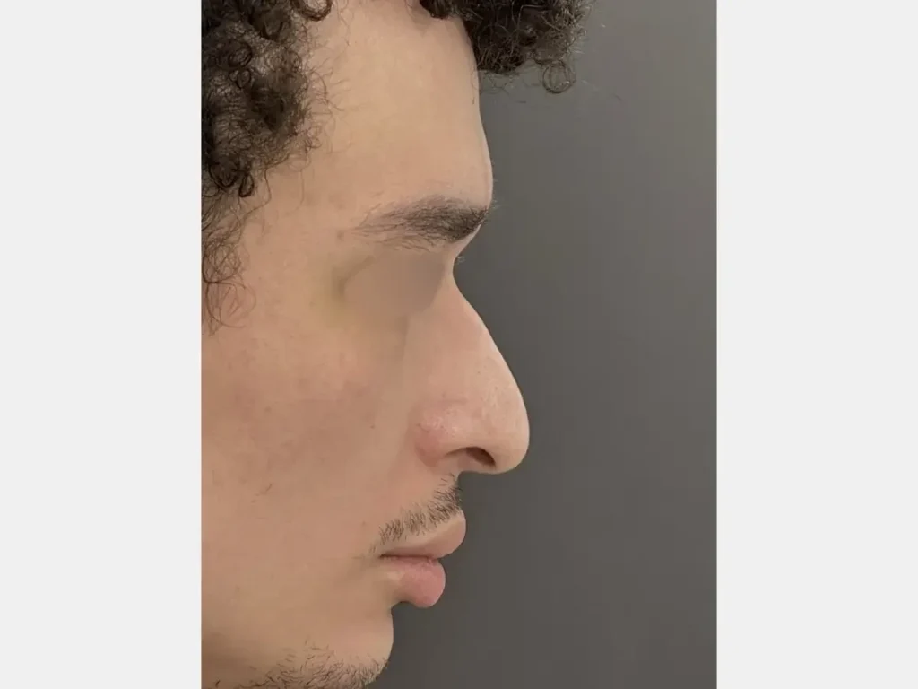 Meio perfil direito mostrando ponta nasal caída e desproporção