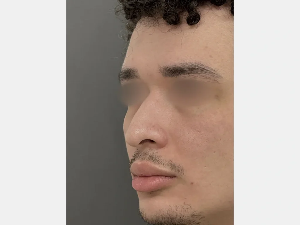 Perfil direito mostrando ponta nasal caída e giba antes da rinoplastia