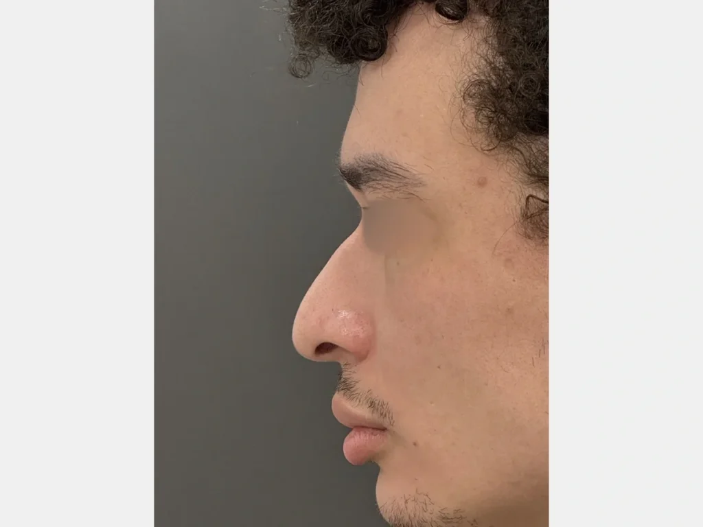 Perfil esquerdo com ponta nasal caída antes da rinoplastia preservadora