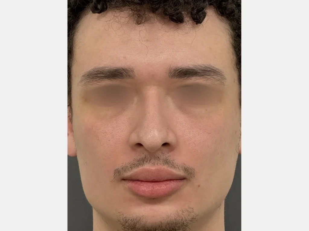 Vista frontal mostrando ponta nasal caída e assimetria antes da rinoplastia