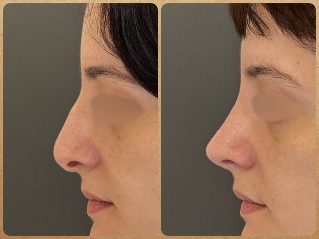 Imagem de antes e depois de uma rinoplastia preservadora realizada pelo Dr. Luis Felipe Athayde, mostrando a correção da giba nasal, columela e o refinamento da ponta.
