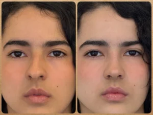 Visão frontal pré-operatória de nariz torto antes de rinoplastia preservadora Dr. Luis Felipe Athayde