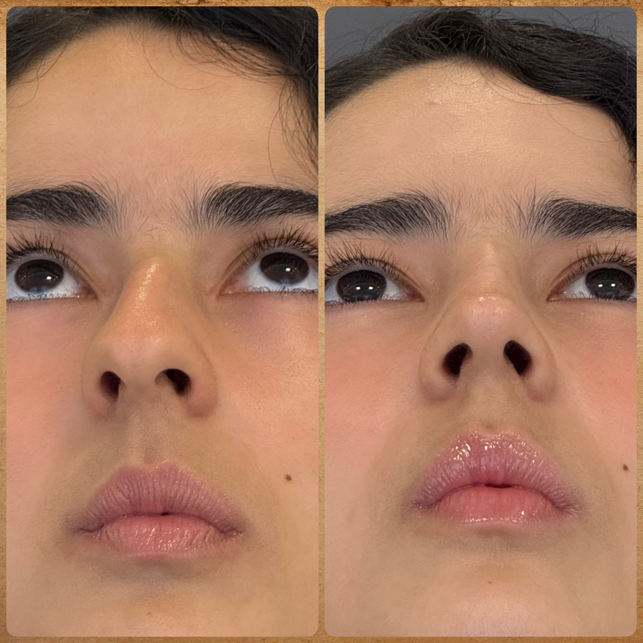 Antes e depois (1 mês): rinoplastia preservadora em nariz torto – visão de base
