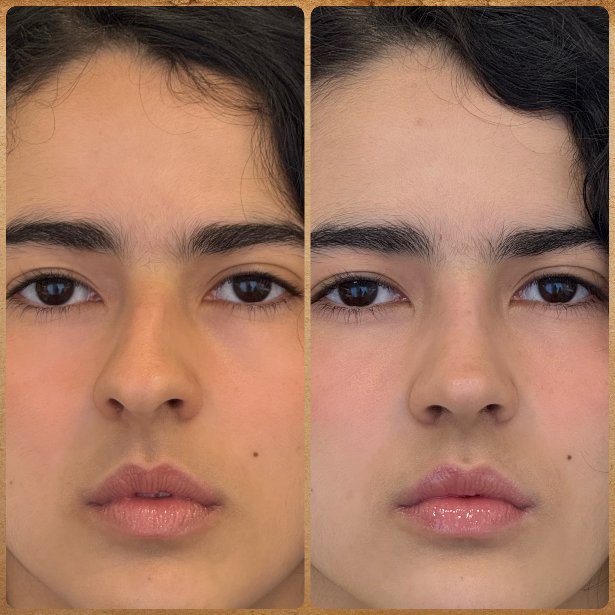Antes e depois (1 mês): rinoplastia preservadora em nariz torto – visão frontal