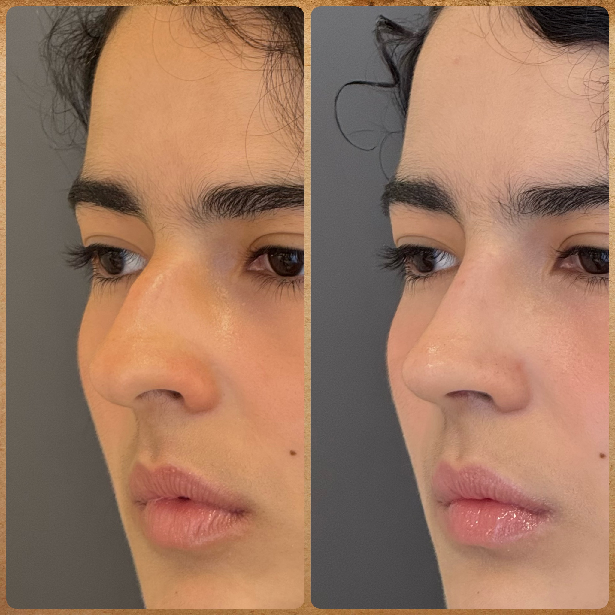 Antes e depois (1 mês): rinoplastia preservadora em nariz torto – visão meio-perfil