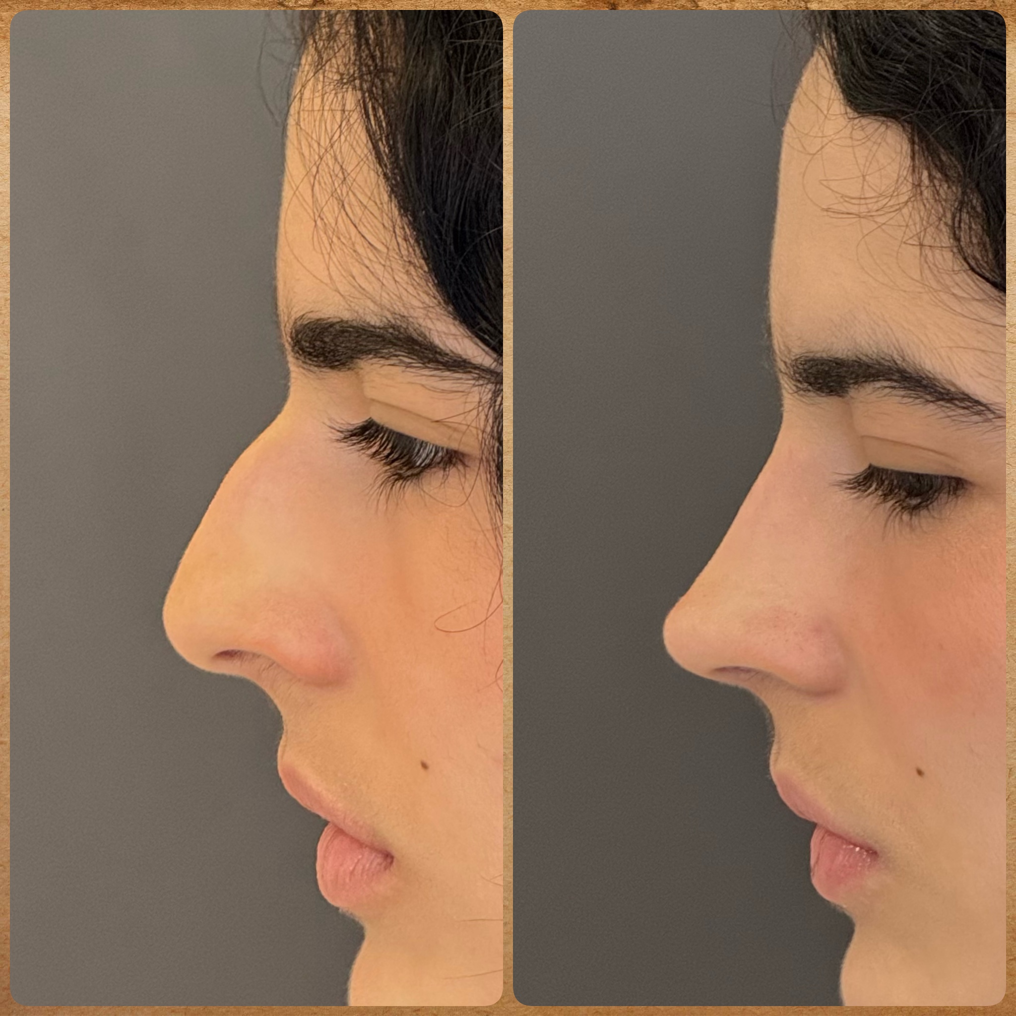 Antes e depois (1 mês): rinoplastia preservadora em nariz torto – visão de perfil