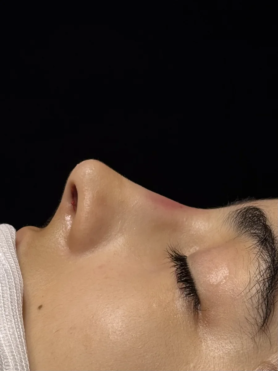 Resultado imediato após rinoplastia preservadora em nariz torto: dorso centralizado e aspecto natural