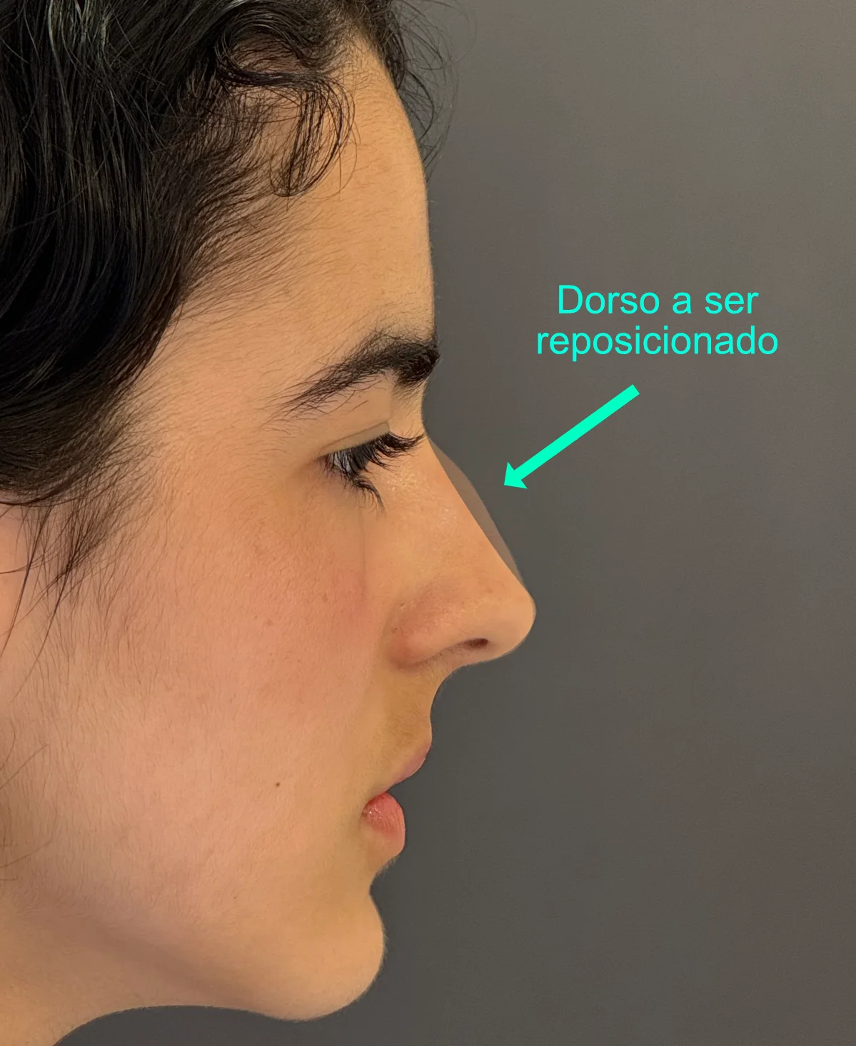 Simulação digital do planejamento: rinoplastia preservadora em nariz torto com redução de giba e leve projeção de ponta