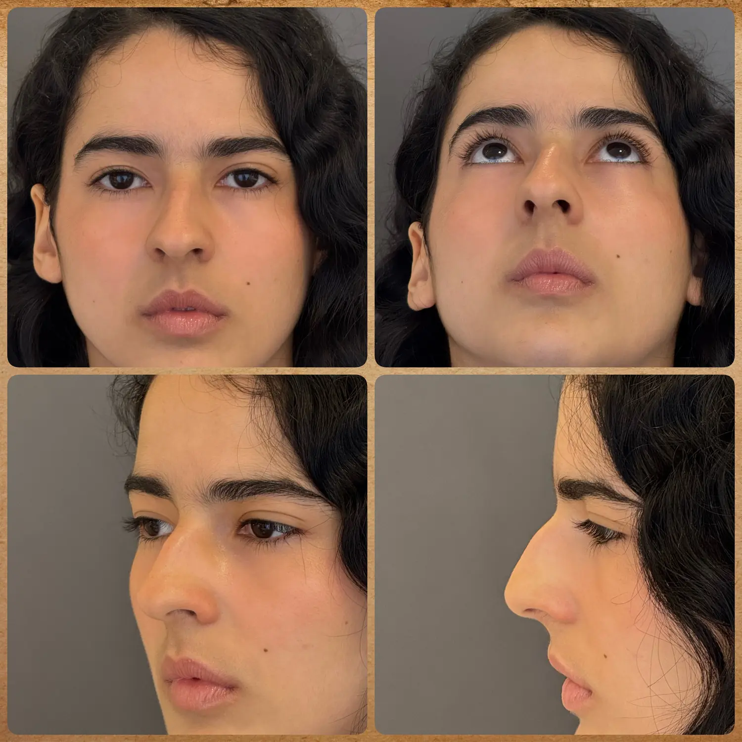 Nariz torto (laterorrinia) no pré-operatório: visão frontal, base, meio-perfil e perfil antes da rinoplastia preservadora