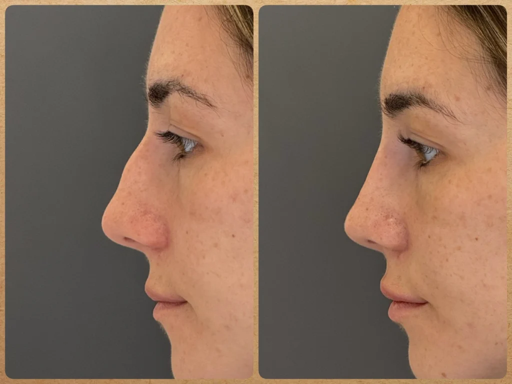 Antes e depois de rinoplastia preservadora, sem cortes externos, para retirada da giba nasal sem alteração da ponta do nariz, com resultado natural e preservação das estruturas nasais. Menor trauma, recuperação mais rápida e melhora da respiração