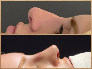 Resultado de antes e depois de rinoplastia preservadora para melhora de nariz grande realizada pelo Dr. Luis Felipe Athayde